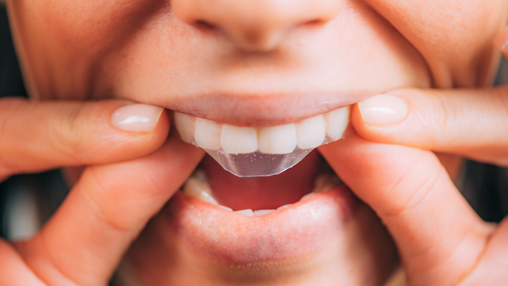 Hogyan lehet fehéríteni a fogakat és elérni a látható fehérítő hatást